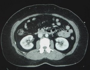 CT nieren