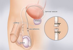 Urologisch Centrum Kennemerland Sterilisatie man, vasectomie Urologisch Centrum Kennemerland Sterilisatie Man, Vasectomie