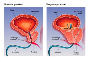 BPH vergroting