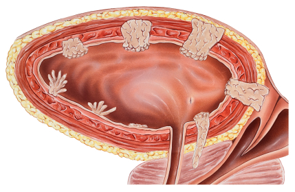 Cancer of the urinary bladder and bladder wall, cutaway side view. Shown are the seven stages of vesical neoplasm development, beginning at the bottom of the bladder and continuing in a clockwise manner. Also shown are the perivesical fat, deep muscle, superficial muscle, submucosa, and mucosa.